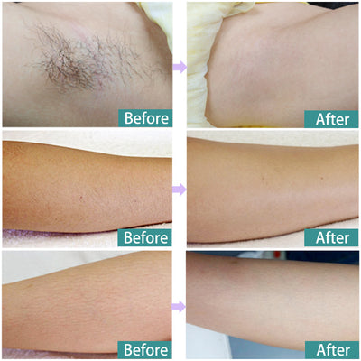 Laser Hair Removal Permanent Epilator