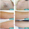 Laser Hair Removal Permanent Epilator